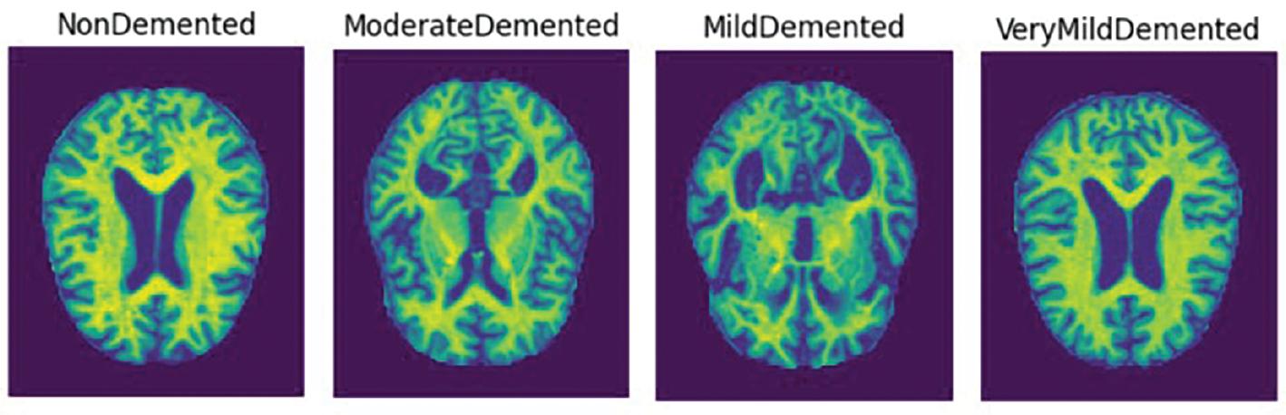 A sample of magnetic resonance imaging images from the dataset represents four classes of Alzheimer’s disease